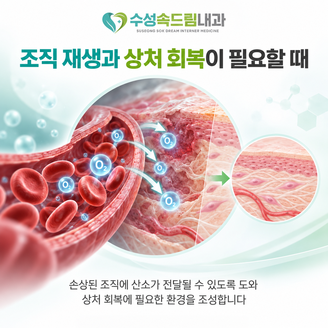 빠른 조직 재생과 상처 회복을 위한 고압산소치료